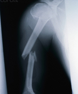 Name:  BrokenBone.jpg
Views: 966
Size:  53.0 KB